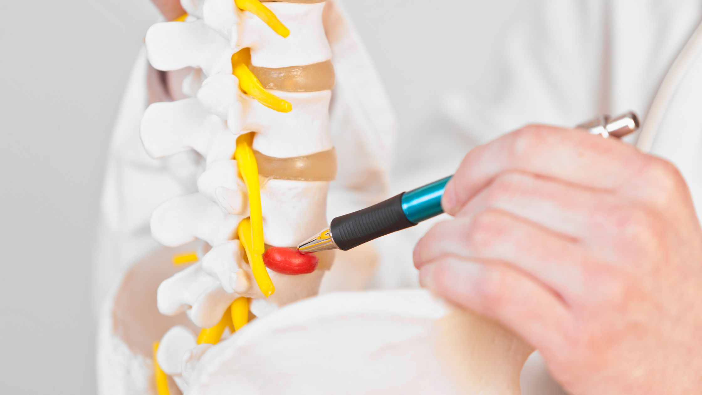 model of a herniated disc doctor pointing