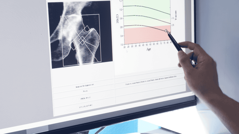 Bone Density Study 101: Everything You Need to Know - Precision Spine Care