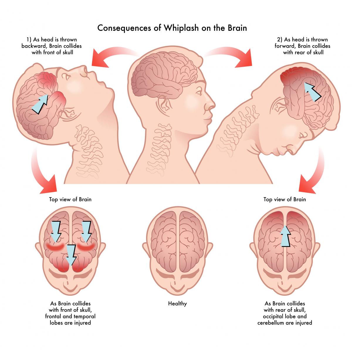What-Is-Whiplash-and-What-Are-the-Symptoms-of-Severe-Whiplash